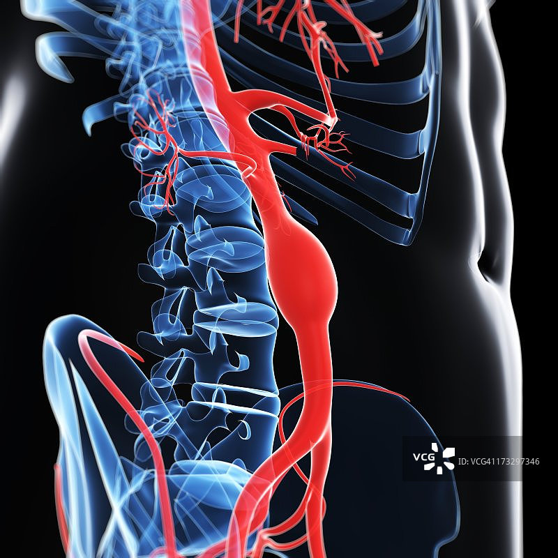 主动脉瘤（医学插图）图片素材