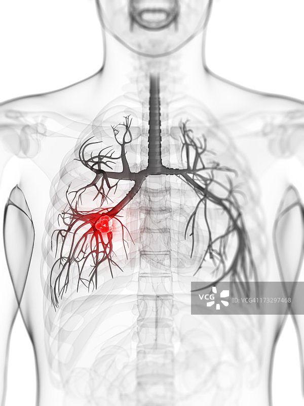肺癌艺术作品图片素材