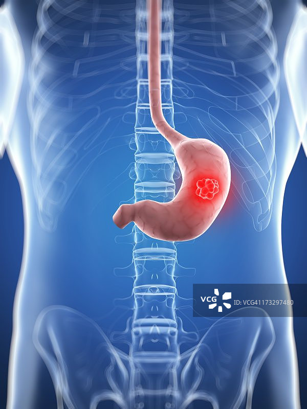 胃癌医学插图图片素材