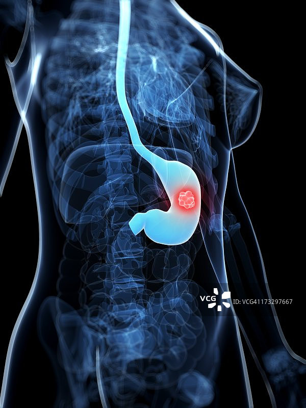 胃癌医学插图图片素材