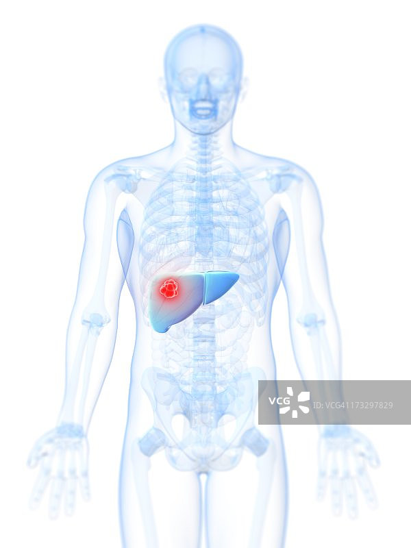 肝癌艺术作品图片素材