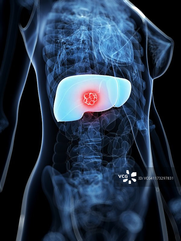 肝癌艺术作品图片素材