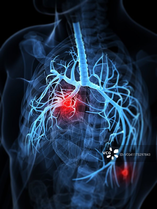 肺癌艺术作品图片素材