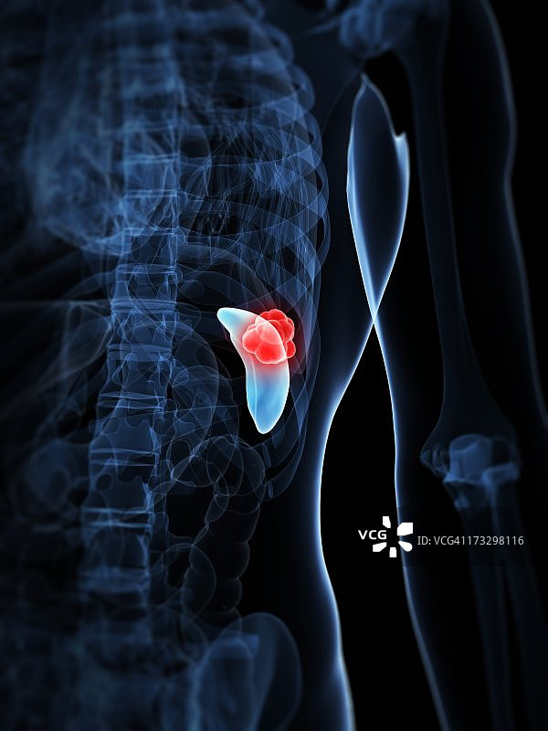 脾脏癌艺术图图片素材