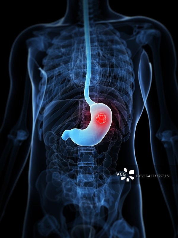 胃癌医学插图图片素材