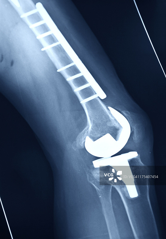 膝关节置换手术成功的数字X光片图片素材