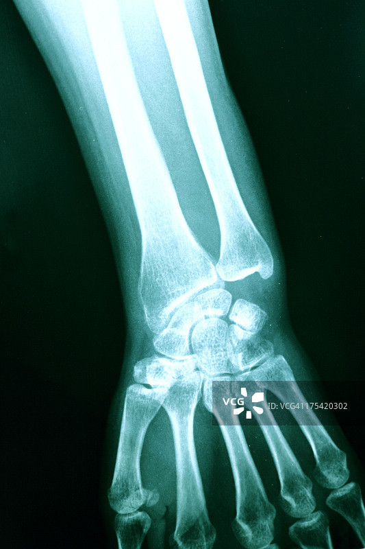 手部X光影像图片素材
