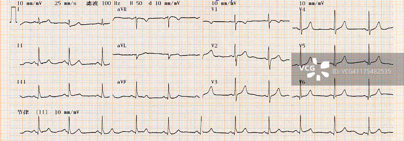 心电图图片素材
