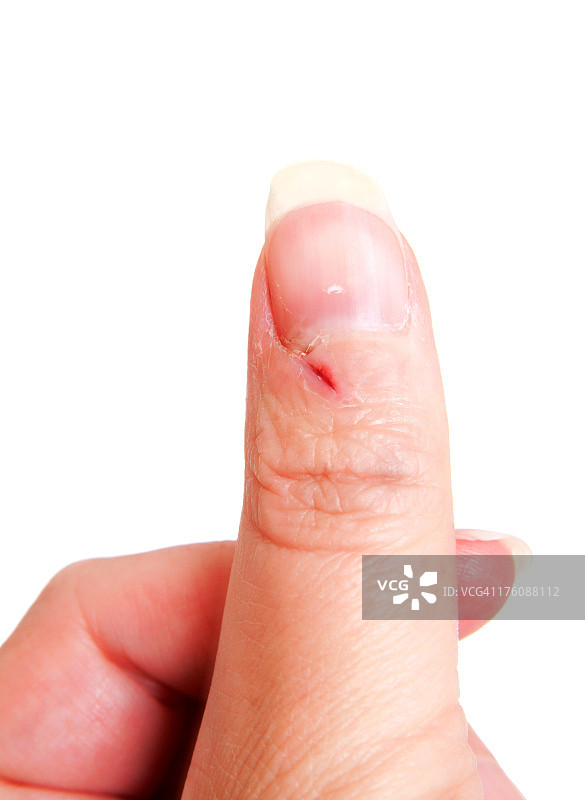 拇指受伤的白人妇女系列9图片素材