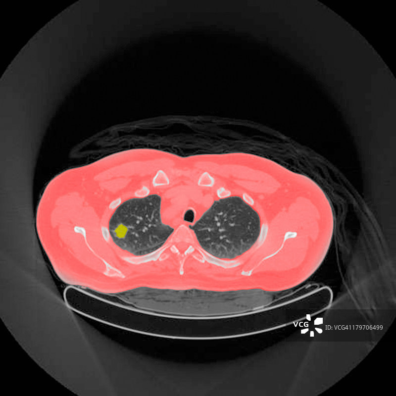 54岁男性患者的PET扫描：左肺上叶肿瘤图片素材