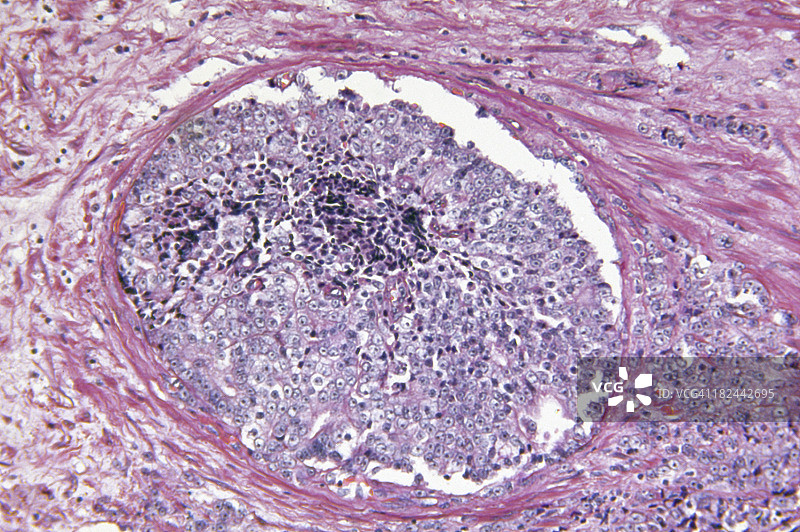 前列腺腺癌图片素材