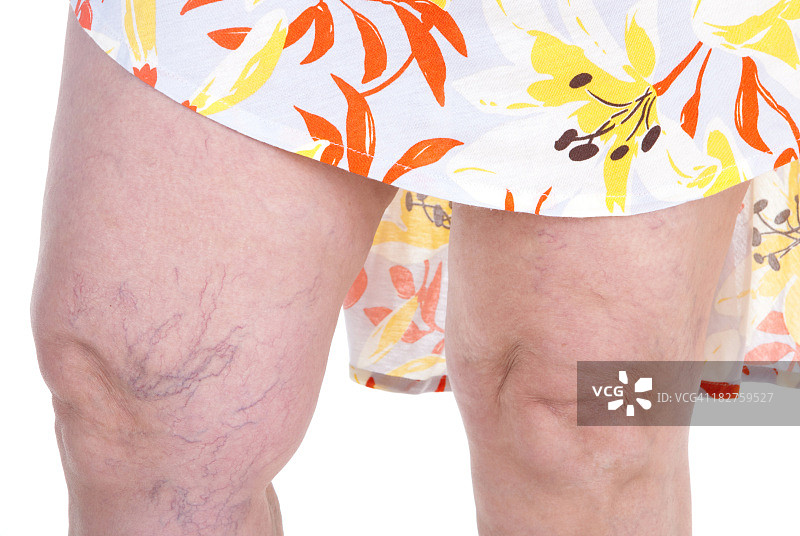 静脉曲张图片素材