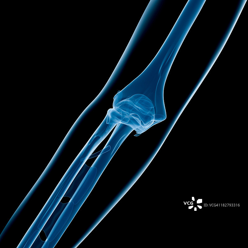 肘部X光片图片素材
