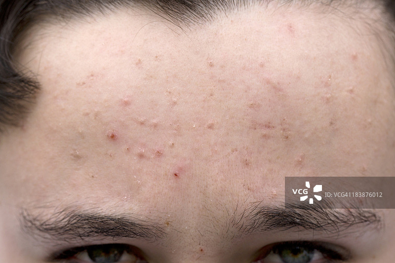 青少年皮肤问题图片素材