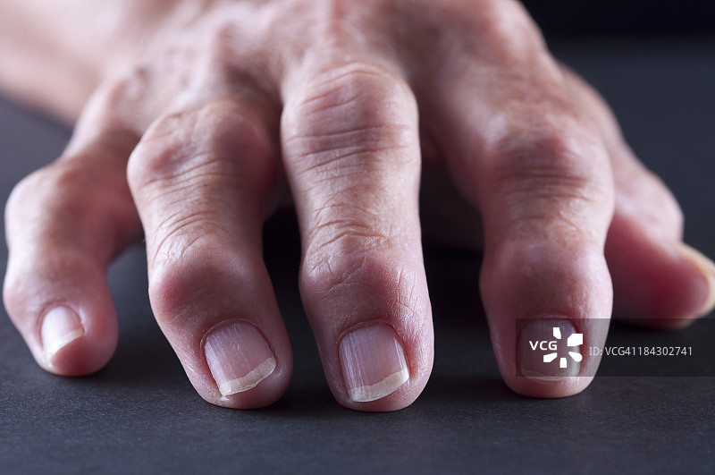 关节炎手部图片素材