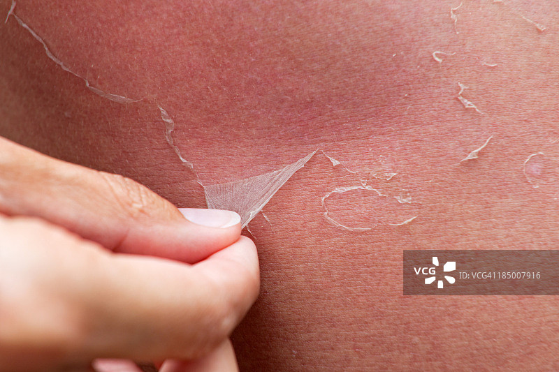 皮肤脱皮，严重晒伤（XXXL）图片素材