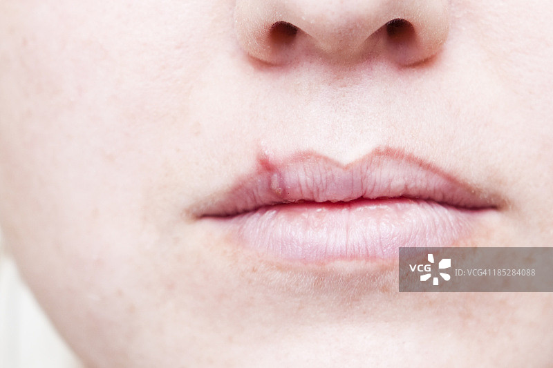 唇部疱疹图片素材