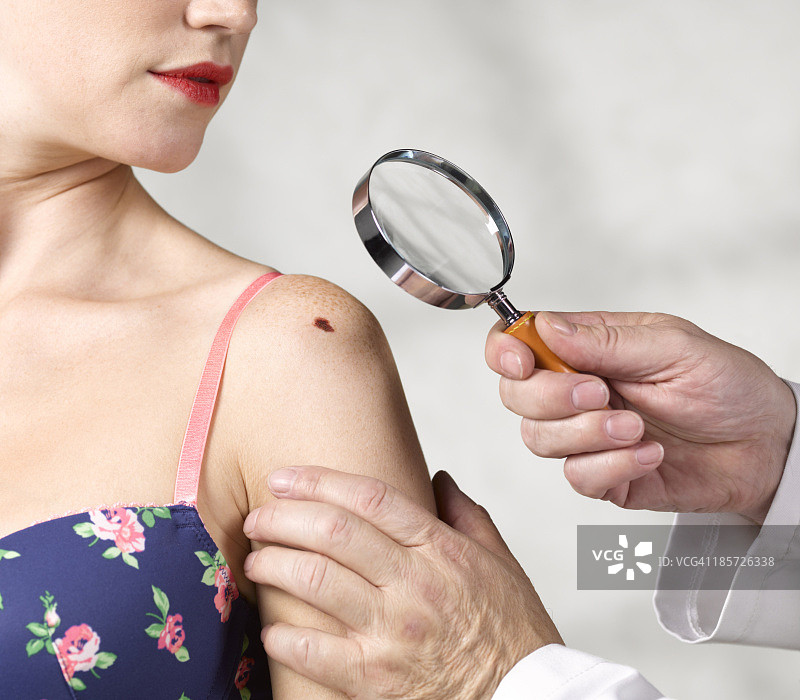 皮肤科医生检查黑色素瘤图片素材