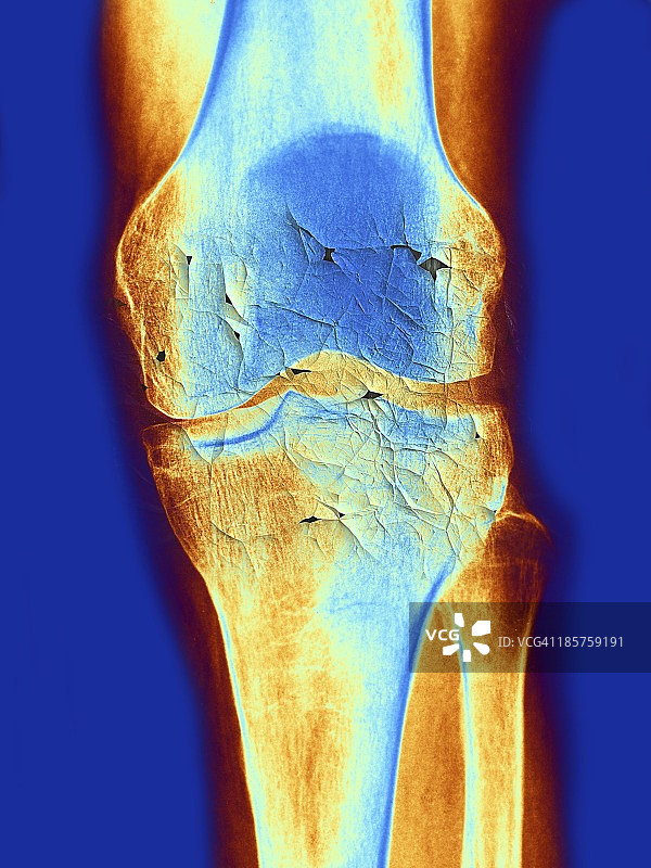 膝关节X光片艺术图图片素材