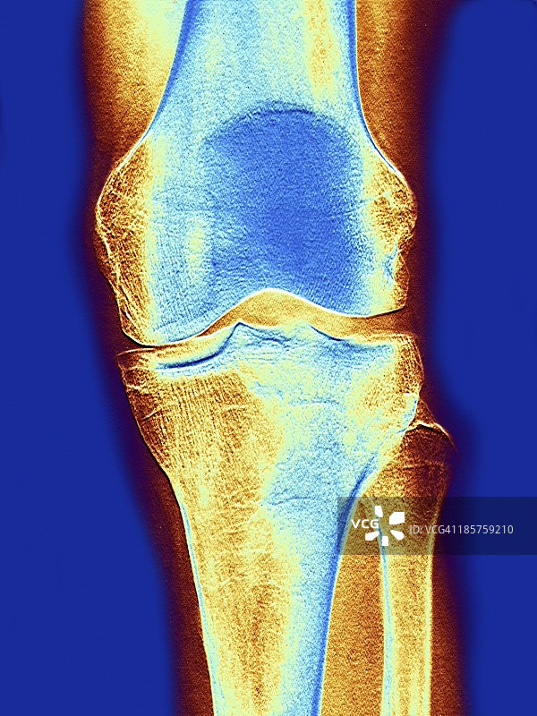 膝关节X光片图片素材