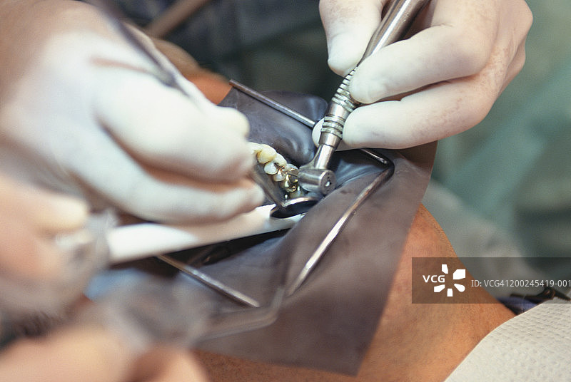 接受牙科治疗的男人（口腔特写）图片素材