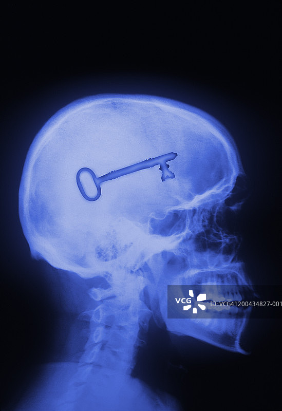 人头侧视图X光片，显示脑腔内的钥匙图片素材