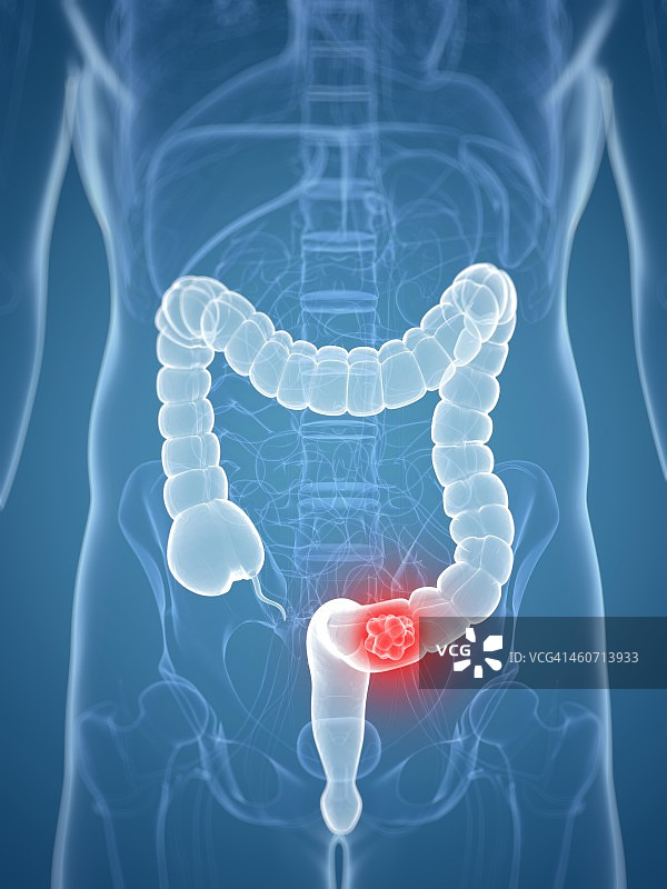 结肠癌，艺术作品图片素材