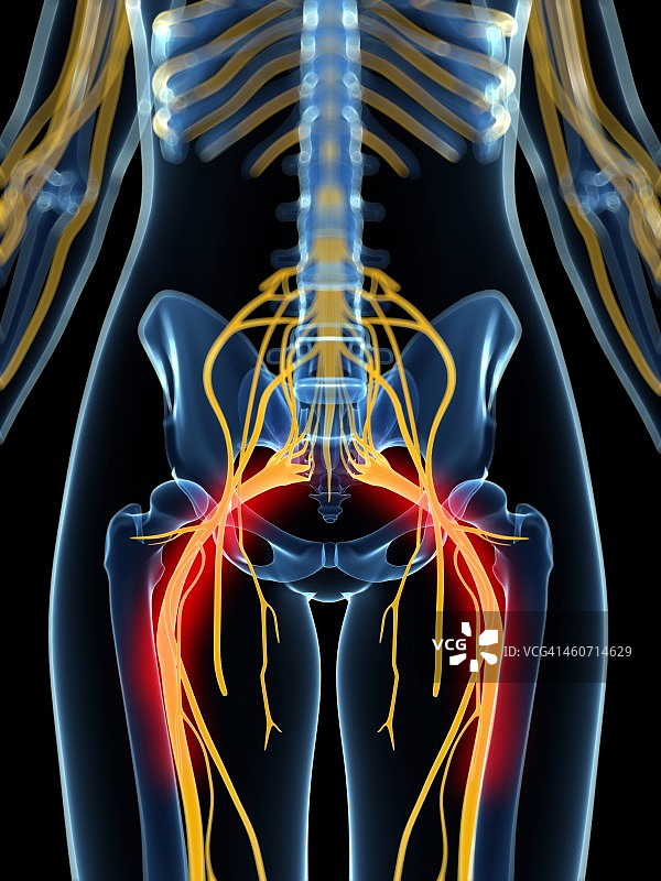 坐骨神经疼痛图片素材