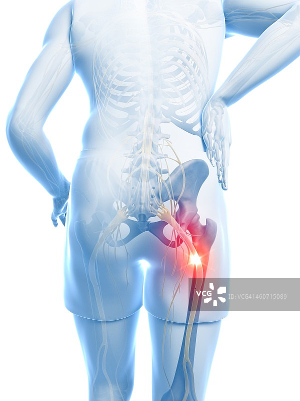 坐骨神经痛示意图图片素材