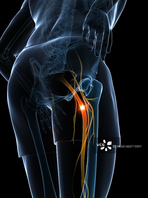 坐骨神经痛示意图图片素材