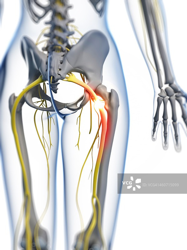 坐骨神经痛示意图图片素材
