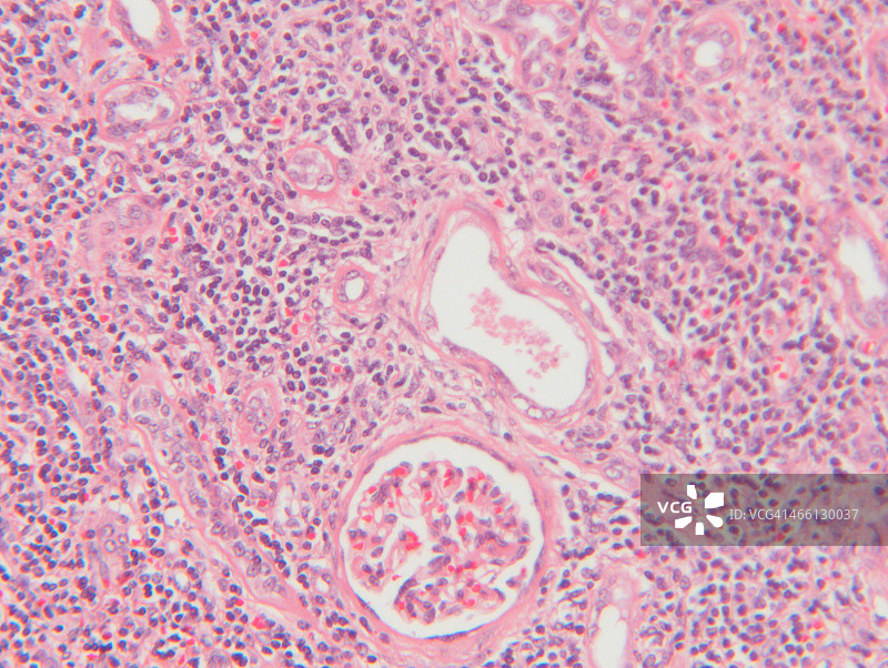 组织学显微照片：H&E染色肾衰竭伴间质性肾炎图片素材