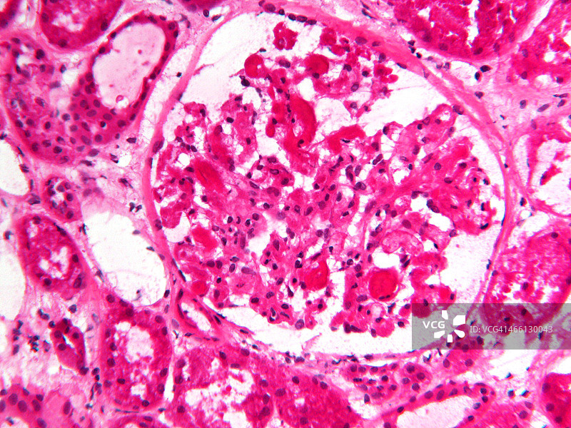组织学显微照片：H&E染色肾衰竭伴间质性肾炎图片素材