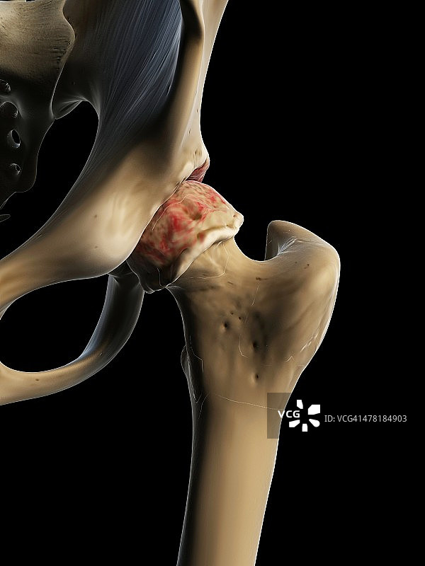 关节炎髋部插画图片素材