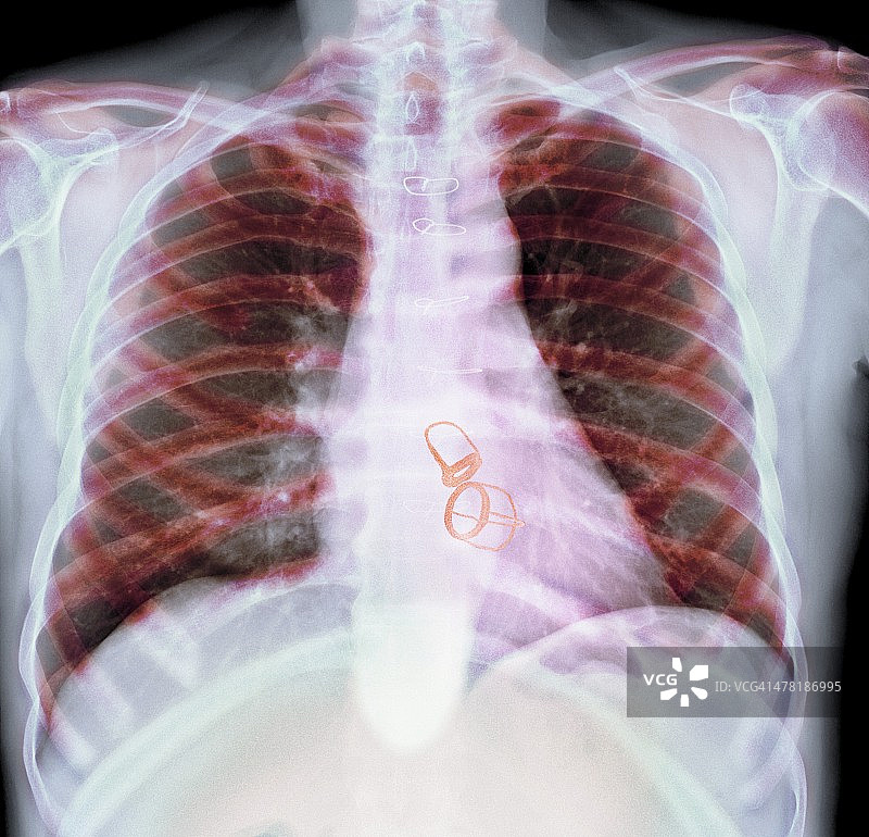 假体心脏瓣膜X光片图片素材