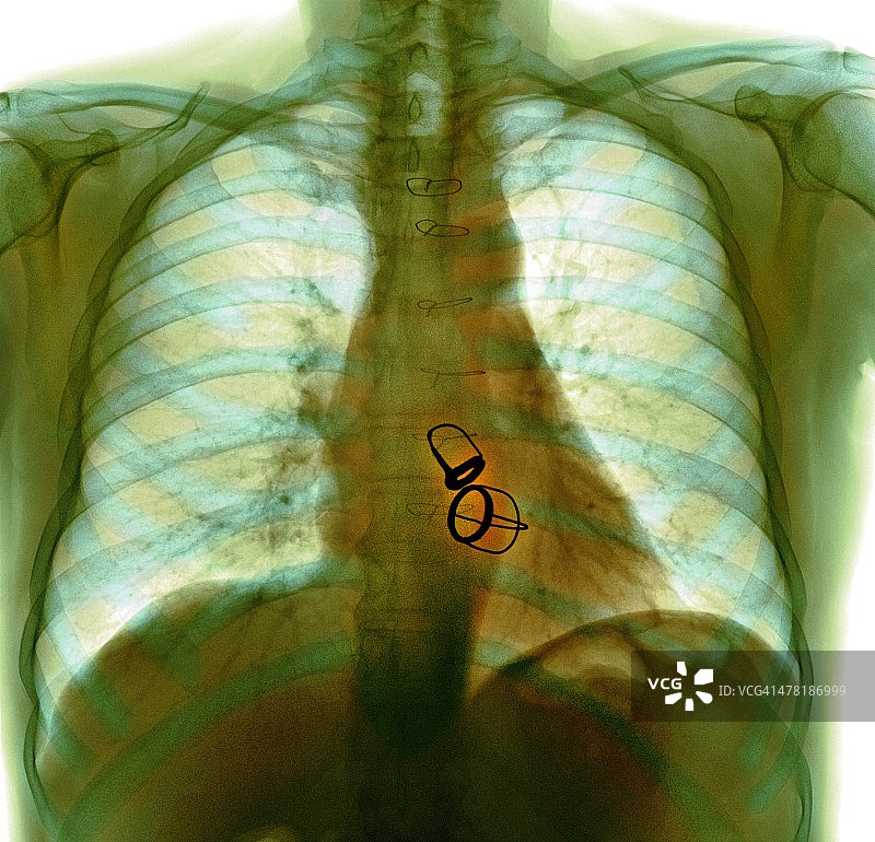 假体心脏瓣膜X光片图片素材