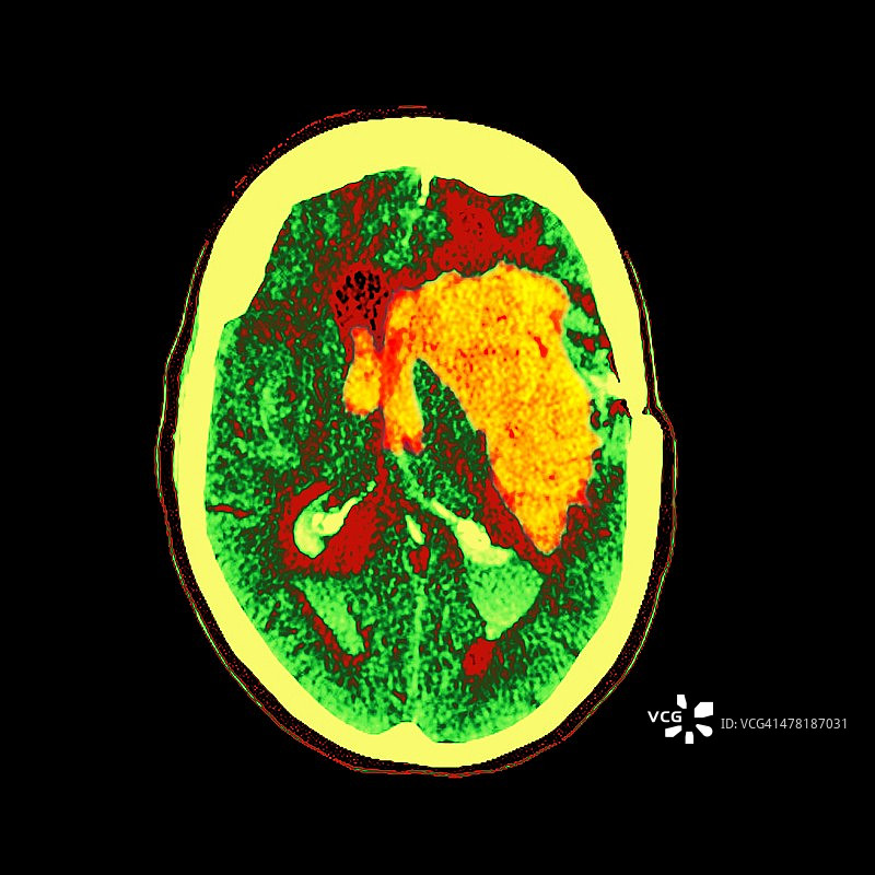 脑出血，核磁共振扫描图片素材