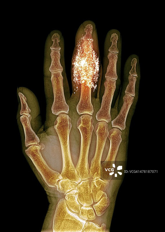 手指异物X光片图片素材