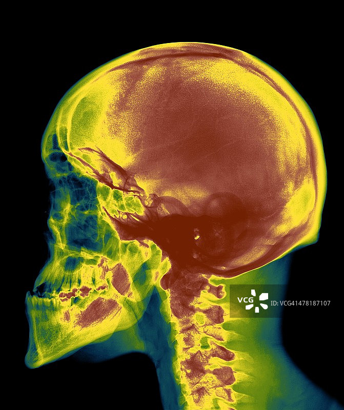 气枪伤，X光片图片素材