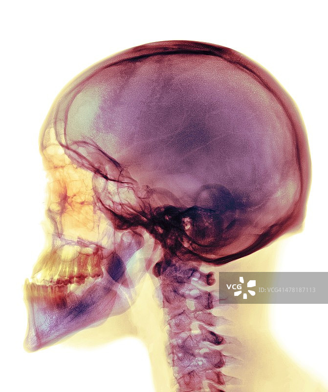 气枪伤，X光片图片素材