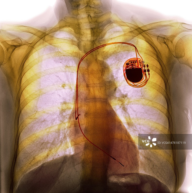 双腔起搏器X光片图片素材