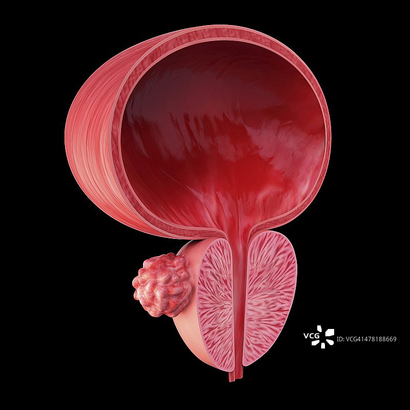 前列腺肿瘤医学插图图片素材