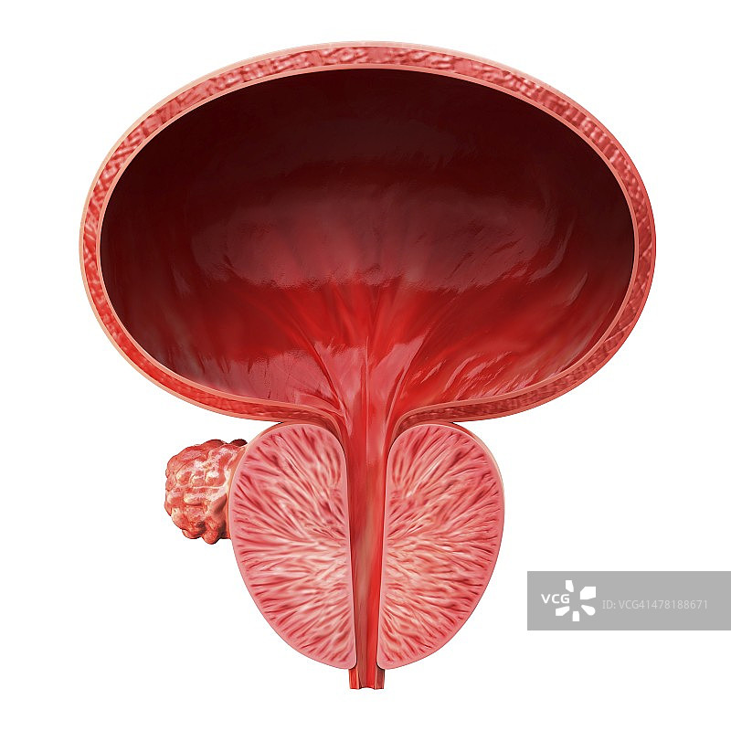 前列腺肿瘤医学插图图片素材