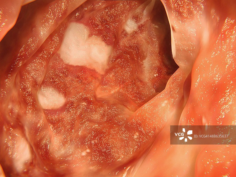 溃疡性结肠炎医学插画图片素材