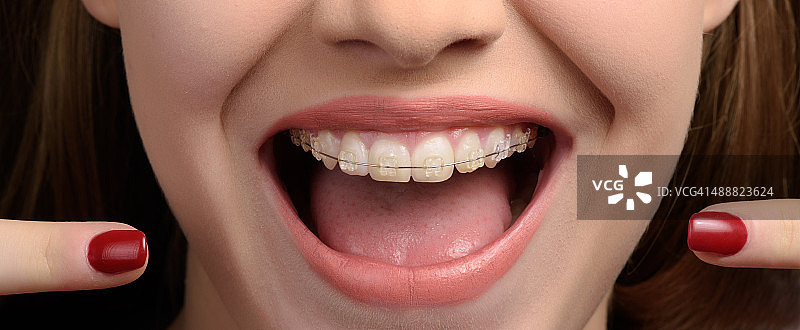 展示我的牙套图片素材