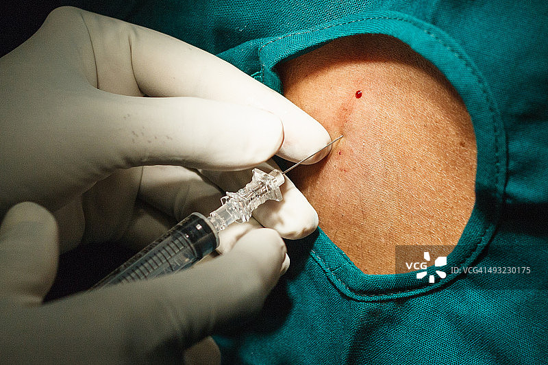 脊髓麻醉图片素材