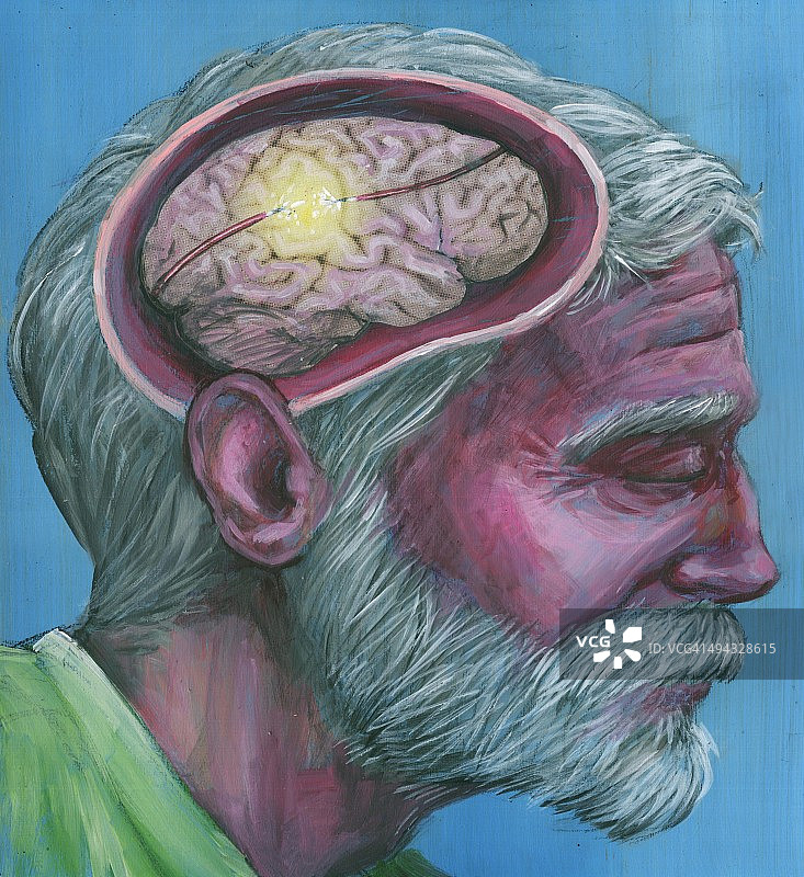 患有阿尔茨海默病的老年男人插画图片素材