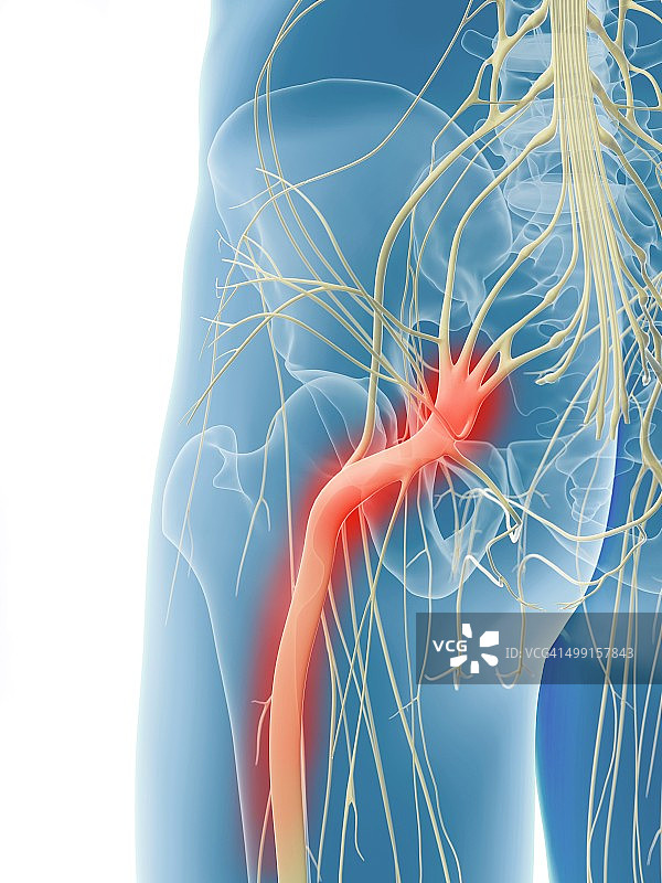 发炎的坐骨神经，艺术作品图片素材