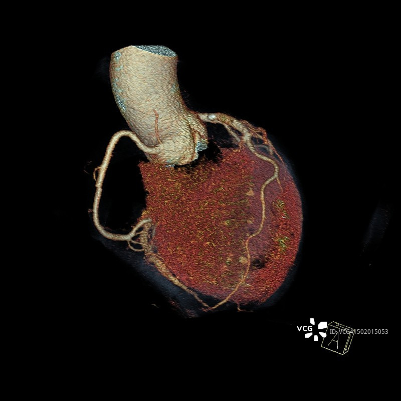 心脏CT图片素材