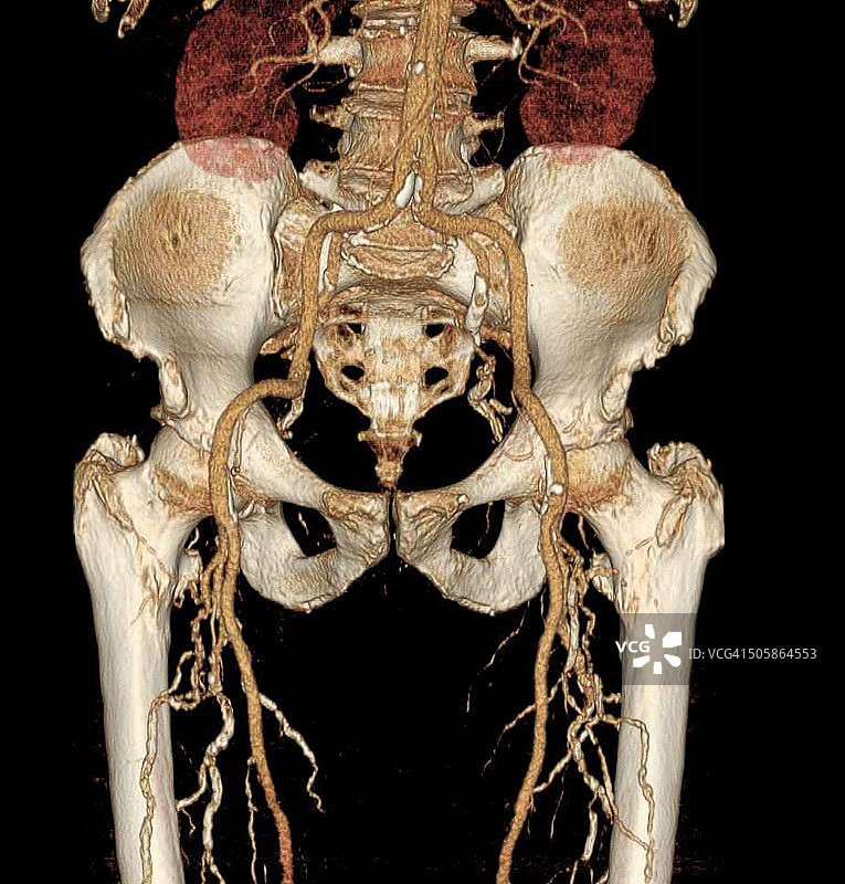 骨盆和腿部的3DCT血管造影图片素材
